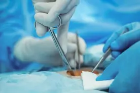 女子剖宫产手术，纱布遗留体内14年！什么情况？图片