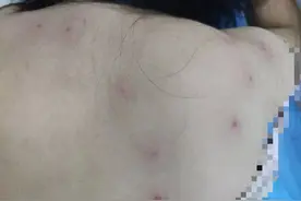 被马蜂蛰伤40余处！泉州一阿婆踩蜂窝险丧命图片