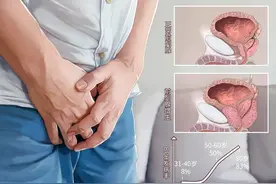 【朝医科普】什么是前列腺增生图片