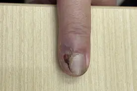 指甲缝长出怪东西！医生切开后倒吸凉气：皮肤癌中的“头号杀手”图片