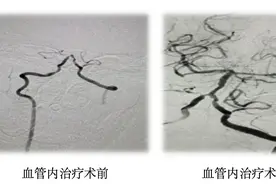突发急性脑梗死，血管内微创手术效果立竿见影图片