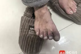 脚趾变蓝，罕见的蓝趾综合征被发现图片