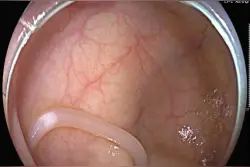 深圳女子腹痛就医揪出肠道蛔虫，生吃食物暗藏健康风险图片