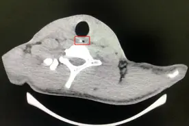 15岁男孩吃烤鸡，竟吃进手术室图片