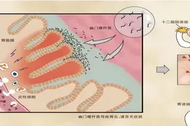 “全民全生命周期健康管理计划”系列科普 | 慢性萎缩性胃炎图片