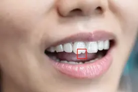 门牙上的“豁口”是嗑瓜子嗑出来的？图片