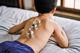 关于拔罐的误区，你知道多少？图片