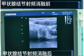 女子患甲状腺4类结节担心得失眠，射频消融术解“心结”图片