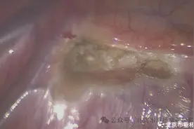 【垂医病例科普】胸外科：告别“汗手”之忧 | 手汗症微创手术全知晓图片