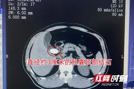 男子患胆囊结石术前“临阵退缩” 谁想竟因此错失保胆绝佳时机图片