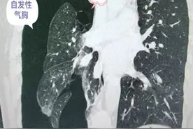 多学科护航 这家医院为多种严重基础病患者切除肺大疱图片