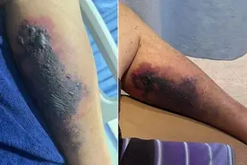 巴西一游客被致命毒蜘蛛咬伤后不治身亡图片