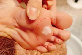 东北游用自发热鞋垫竟低温烫伤！医生提醒——图片