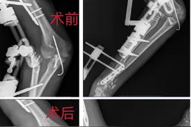 永州市中医医院成功开展上肢多发骨折术后翻修手术图片