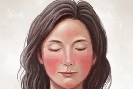 玫瑰痤疮红斑、潮红难治，疗法再创新！图片