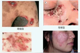 揭秘天疱疮——一场皮肤上的“泡泡”挑战图片