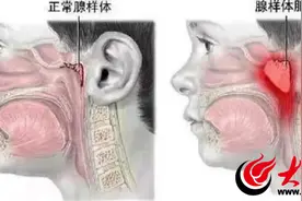 曲阜市第二人民医院健康科普——关注腺样体 呵护儿童健康图片