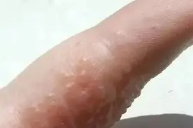 密密麻麻！奇痒无比！镇江不少人躲不过图片