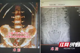 男子小便刺痛还带血却当上火没在意 偶然体检才知是结石在作怪图片