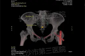 微创+机器人，骨折复位新标杆图片
