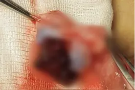 10岁男孩的蛋蛋，被同学一脚踢碎……医生：每月接诊二三十例图片