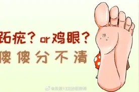 如何正确区分瘊子和鸡眼？图片