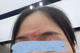 危险！宁波女子在商场里被无人机撞脸，“会留疤”！更气人的是……图片