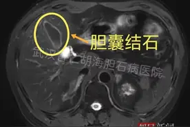 过早爱油炸食物、“快乐水”成升喝，男子胆囊内长出5厘米“石膏样”结石图片