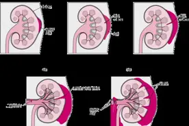 每天按摩半小时，女子出现肾挫裂伤！医生提醒图片