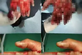 一声爆响 双手受伤 驻马店魏道德骨科医院提醒：欢乐时刻莫忘安全图片