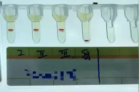 全球罕见！云南检出一例“小p血型”，比熊猫血还稀有！图片