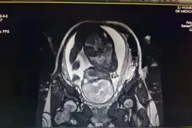 全国首例！差点一脚“踢出”子宫的宝宝，平安降生啦图片