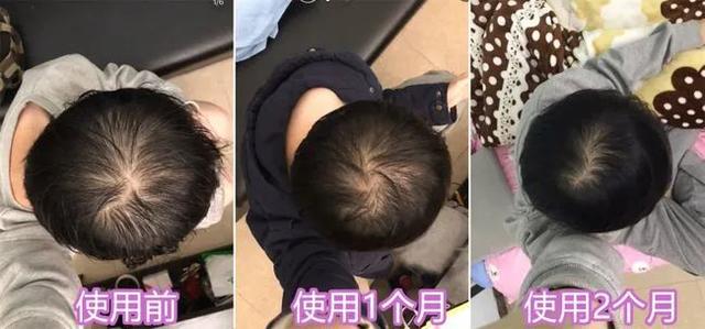 头上扣下来的白泥竟然是螨虫尸体！头痒头屑出油多，用TA就对了