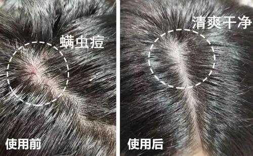 头上扣下来的白泥竟然是螨虫尸体！头痒头屑出油多，用TA就对了