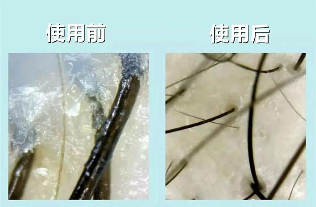 头上扣下来的白泥竟然是螨虫尸体！头痒头屑出油多，用TA就对了