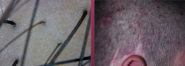 头上扣下来的白泥竟然是螨虫尸体！头痒头屑出油多，用TA就对了