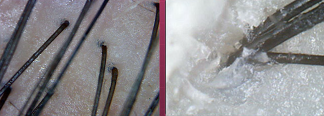 头上扣下来的白泥竟然是螨虫尸体！头痒头屑出油多，用TA就对了