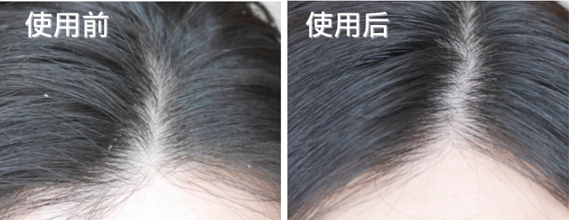 头上扣下来的白泥竟然是螨虫尸体！头痒头屑出油多，用TA就对了