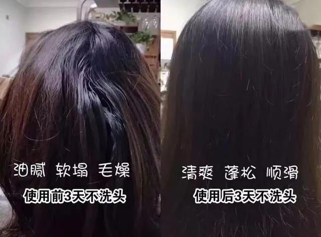 头上扣下来的白泥竟然是螨虫尸体！头痒头屑出油多，用TA就对了