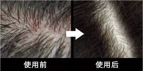 头上扣下来的白泥竟然是螨虫尸体！头痒头屑出油多，用TA就对了