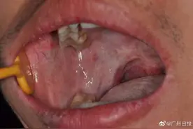 小伙嚼一年槟榔后口腔发生癌前病变图片