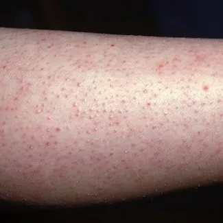 涂身体乳可以去鸡皮疙瘩吗 涂身体乳可以去鸡皮疙瘩吗