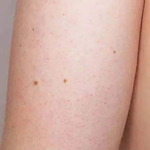 涂身体乳可以去鸡皮疙瘩吗 涂身体乳可以去鸡皮疙瘩吗