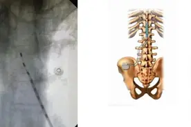 广东一男子身上“生蛇”，偏方治疗后突然晕倒住进ICU！这种病近期高发图片