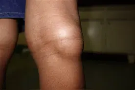 腘窝囊肿，有时候需要把多余的黏液放出来图片
