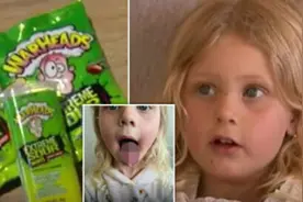 4岁女孩吃酸糖后舌头上被烧了个洞图片