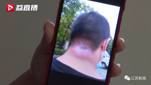脸上长脓包且里面挤出全是坏死的血的痘痘（男子随手挤了颗痘痘）