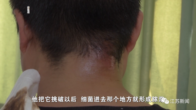 男子随手挤了颗痘痘，结果长出拳头大脓包