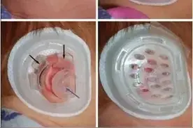 家长注意！招风耳“招财、更聪明”？医生：这是畸形耳图片