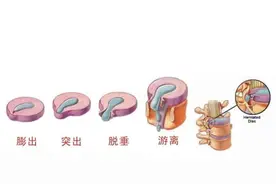 什么是腰椎间盘突出？突出的到底是什么？图片